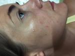 Высыпания на щеках у девушки 30 лет фото 3