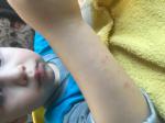 Сыпь на руке у ребёнка фото 2