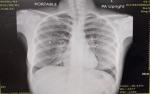 Снимок легких пневмония фото 1