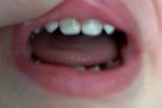 Пятна на молочных зубах фото 1