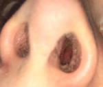 Воспаление в носу фото 1