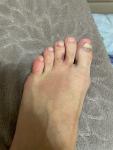 Синяки на пальцах ног фото 2