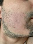 Очаговая алопеция на бороде фото 2