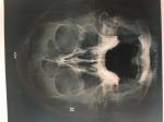Описание рентгена пазух носа фото 1