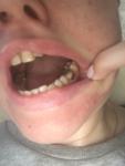 Потемнение зуба у десны фото 1