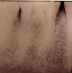 Болит зуб после промбировки фото 1
