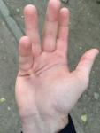 Дефект руки после травмы фото 5