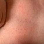 Сыпь у новорождённого аллергия или акне фото 3