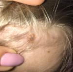 Пятно на голове у ребёнка фото 2