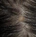 Образование на волосистой части головы фото 1