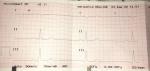 Расшифровка ЭКГ, боль в сердце и быстрое сердцебиение фото 1