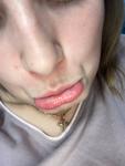 Шелушение слизистой губы фото 3