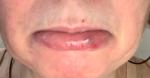 Сгусток крови внутри нижней губы фото 1