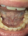 Трещины на зубах фото 2