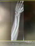 Боль костей и суставов руки после перелома фото 1