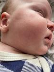 Аллергия или акне новорожденных фото 2