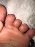 Красная сыпь на мочках пальцах рук и ног фото 3
