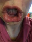 Жжение и отёк языка и губ фото 2