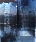 Темные пятна на рентгене пояснично крестцового отдела фото 2