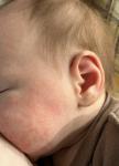 Акне новорожденных или аллергия? фото 3