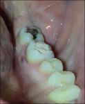Воспаление Десны после того как заложили лекарство в зуб фото 1