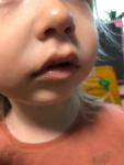 Белое пятно на нижней губе у ребёнка фото 4