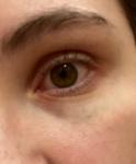 Осложнение на глаза после аллергии фото 2