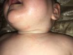 Пятна, сыпь на шее и грудке у младенца фото 2