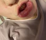 Шелушение слизистой губы фото 4
