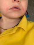 Дерматит на лице у ребенка фото 1
