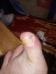 Боль неясного происхождения на пальце ноги фото 1
