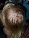 Зудящие прыщи на голове с выпадением волос фото 1