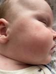 Аллергия или акне новорожденных фото 3