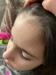 Прыщи по линии волос у ребёнка фото 2
