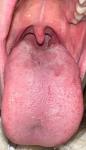 Белый налет на языке с розовыми очагами фото 2