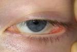 Болит внутренний угол глаза фото 2