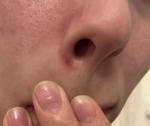 Боль у нижнего края крыла носа без воспаления фото 2