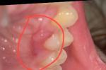 Воспаление десны и уплотнение за зубом фото 1
