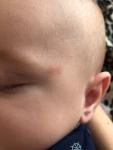 Пятно на лице у ребенка сроком около 2-3 месяцев фото 1