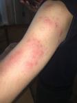Высыпание на руке похожие на укус комара фото 2