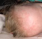 Аллергия на лбу у ребёнка фото 1