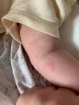 Точечная сыпь у ребенка на руке и животе фото 1