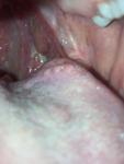 Белый налёт в горле и непроходимый кашель фото 2