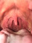 Боль в горле справа Ангина или Коронавирус фото 1