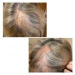 Выпадение волос появление залысин за пол года вся макушка полысела фото 1