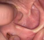 Боль в ушной раковине фото 1
