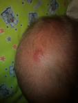 Красное пятно на голове младенца фото 1