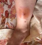 Красное нарастание с уплотнением кожи на ноге фото 1