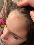 Прыщи по линии волос у ребёнка фото 1