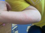 Сыпь на руке, аллергия? фото 1